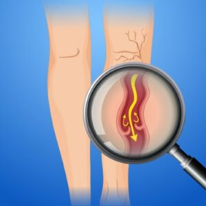 Trombose venosa profunda o que é causas sintomas e tratamentos