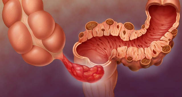 Sintomas Da Diverticulite O Que Causas E Sinais Mundoboaforma