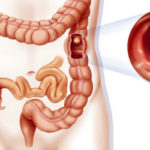 Pólipo no intestino