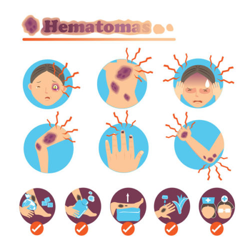 12 Dicas De Como Tirar Hematomas Mais Rapidamente - MundoBoaForma