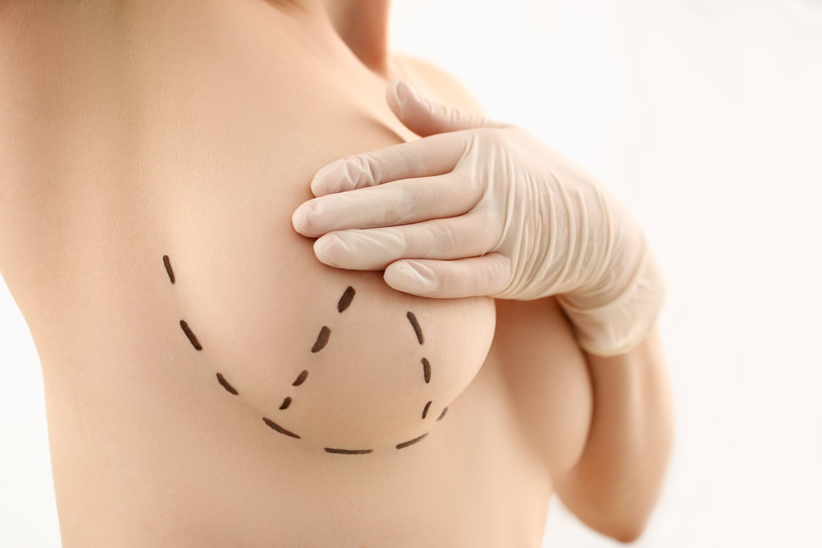 Breast Lift Recovery  American Society of Plastic Surgeons