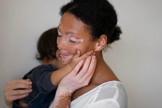 Mãe com vitiligo e seu filho