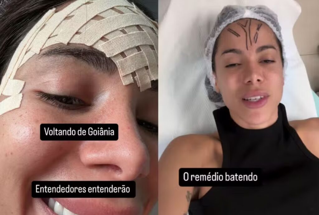 Anitta faz procedimento para retirada de veia na testa; entenda riscos