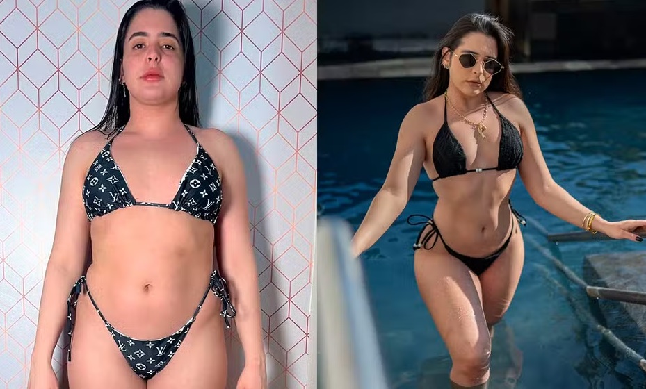 Influencer investe R$ 70 mil em procedimento e retira 4 litros de gordura